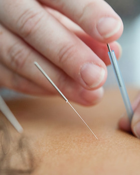 Dry Needling