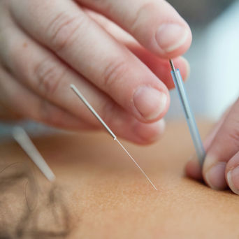 NIH: Acupuncture 
