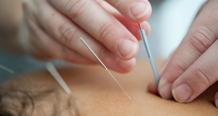 Acupuntura