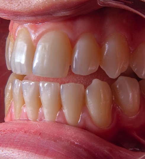 gum contouring penang