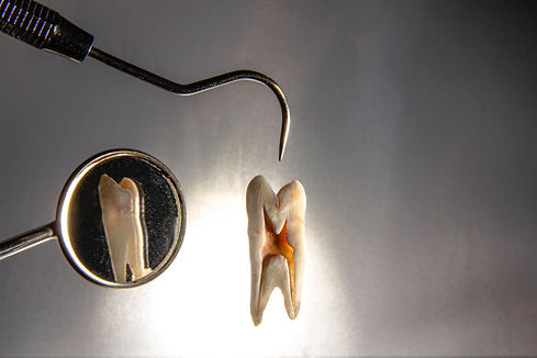 caries dental