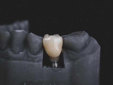 Global Dental Implant Category Series: Evaluation of User Sentiment Toward Leading Dental Implant Brands