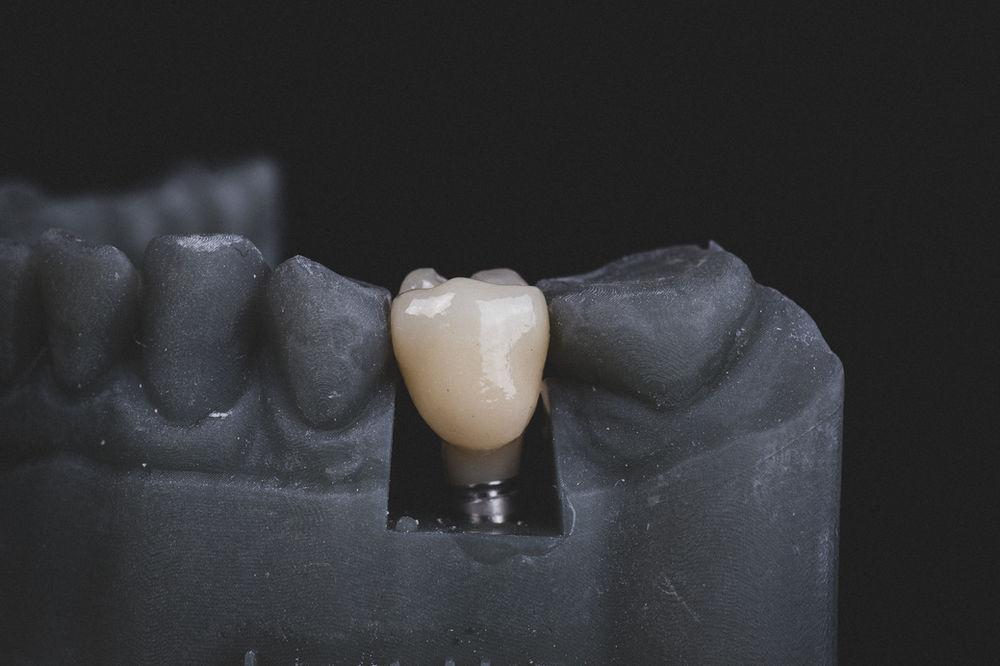 Dental Crown Pain The Complete Guide