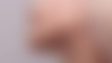 a woman with tmj pain and jaw tension causing masseter pain and headaches