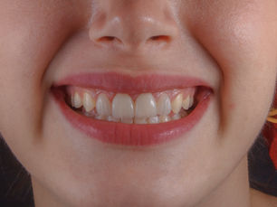What People Get Wrong About Professional Teeth Whitening Today