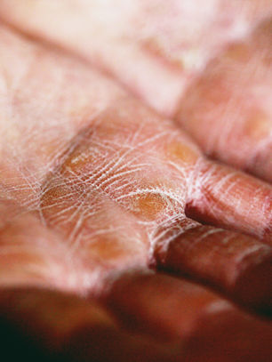 Eczema & Functional Medicine: Understanding the Root Causes and Natural Relief
