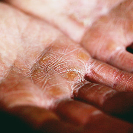 A Guide for What to Know About Eczema
