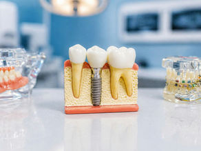 Combien coûte un implant dentaire à Témara ?
