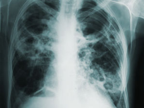 Kansas declara el fin del brote de tuberculosis en el área metropolitana de Kansas City