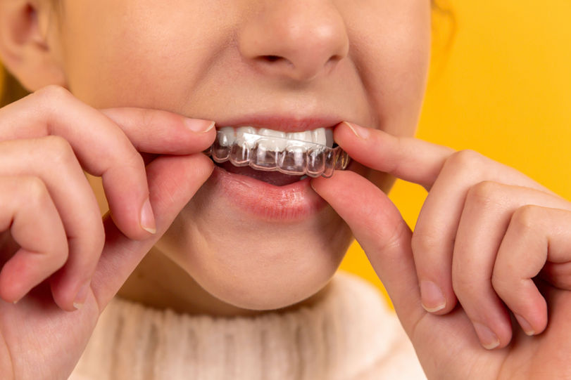 A young woman placing a clear aligner into her mouth